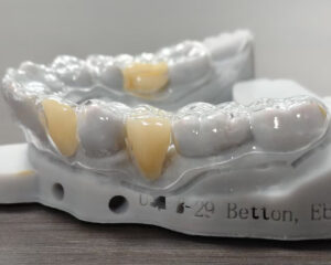 Clear Aligner
