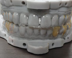 Clear Aligner
