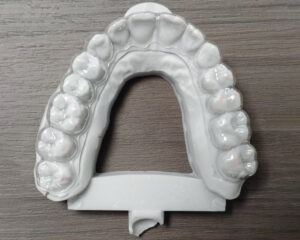Clear Aligner