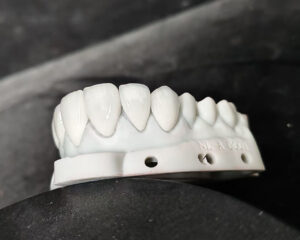 E.Max Veneer