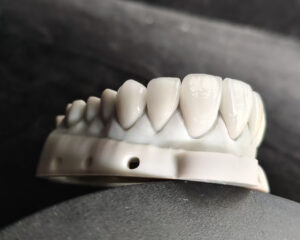 E.Max Veneer