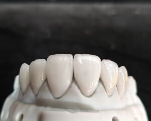 E.Max Veneer