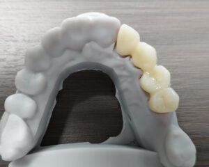 Full Contour Zirconia Bridge