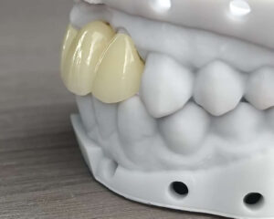Full Contour Zirconia Bridge