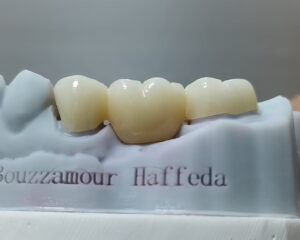 Full Contour Zirconia Bridge