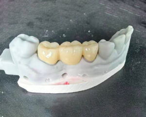 Full Contour Zirconia Bridge