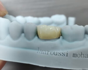 Full Contour Zirconia Crown