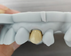 Full Contour Zirconia Crown
