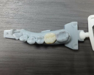Full Contour Zirconia Crown
