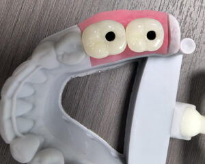Implant Emax Crown