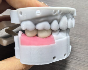 Implant Emax Crown