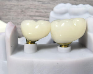 Implant Emax Crown