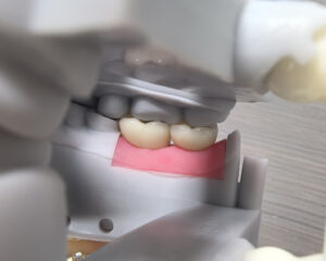 Implant Emax Crown