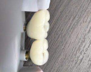Implant Emax Crown