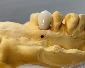 Implant PFM Crown