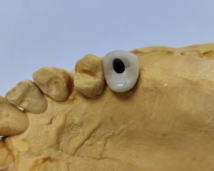 Implant PFM Crown