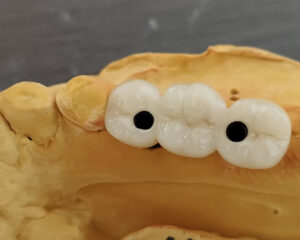Implant PFM Crown