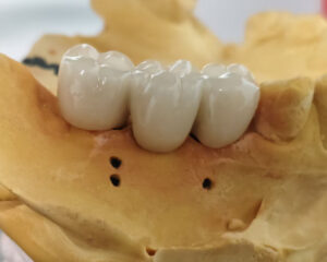 Implant PFM Crown