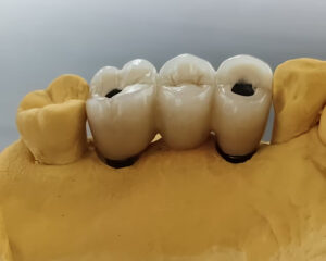 Implant PFM Crown