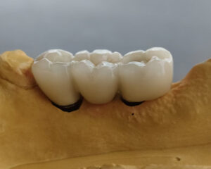 Implant PFM Crown