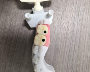 Implant Zirconia Crown