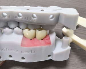 Implant Zirconia Crown