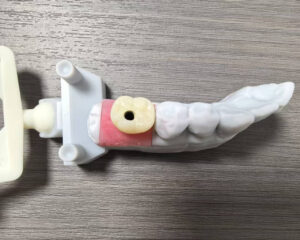 Implant Zirconia Crown