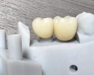 Implant Zirconia Crown