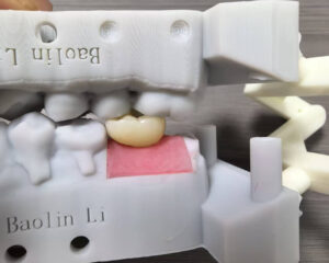 Implant Zirconia Crown