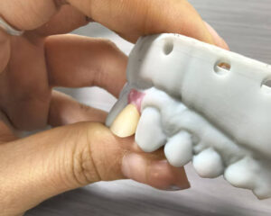 Implant Zirconia Crown