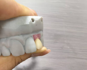 Implant Zirconia Crown