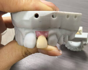 Implant Zirconia Crown