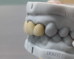 Layered Zirconia Bridge