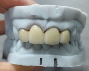 Layered Zirconia Bridge