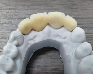 Layered Zirconia Bridge
