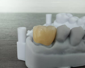 Multi-layer Full Zirconia Crown