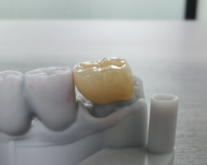 Multi-layer Full Zirconia Crown