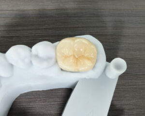 Multi-layer Full Zirconia Crown