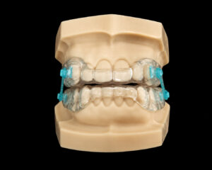 Silensor Anti-snoring Appliance