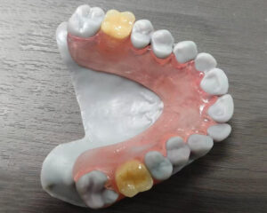 Flexible Denture