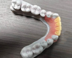 Flexible Denture