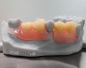 Flexible Denture