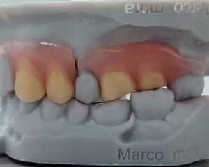 Flexible Denture