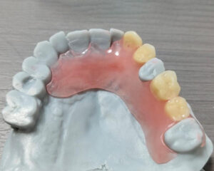 Flexible Denture