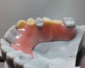 Flexible Denture